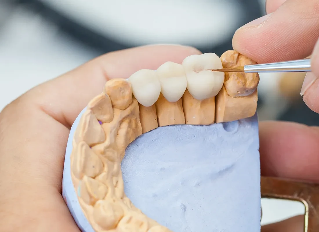 Bridging the Gap: Complete Your Smile with Dental Bridges at Woodland Hills Family Dentistry