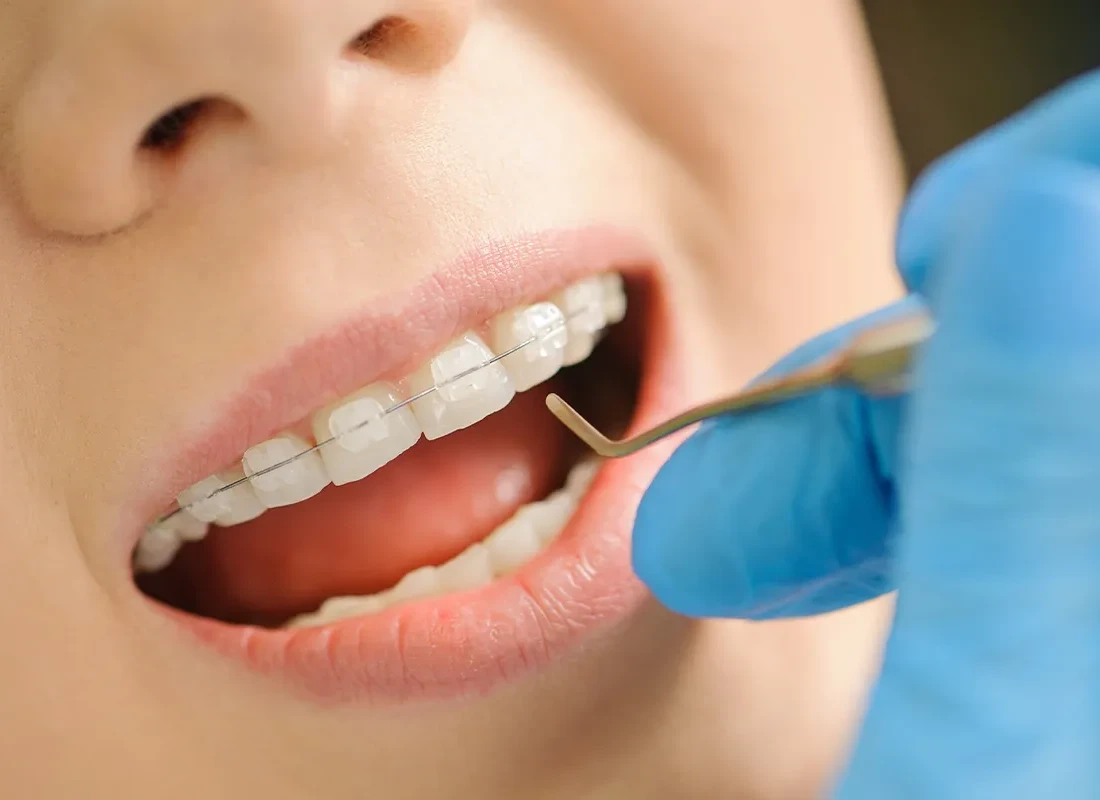 How Can You Tell If You Have a Cavity?