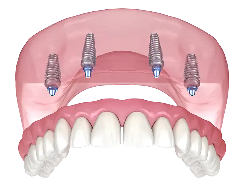 All-on-4 Implants: The Key to Restoring Your Smile