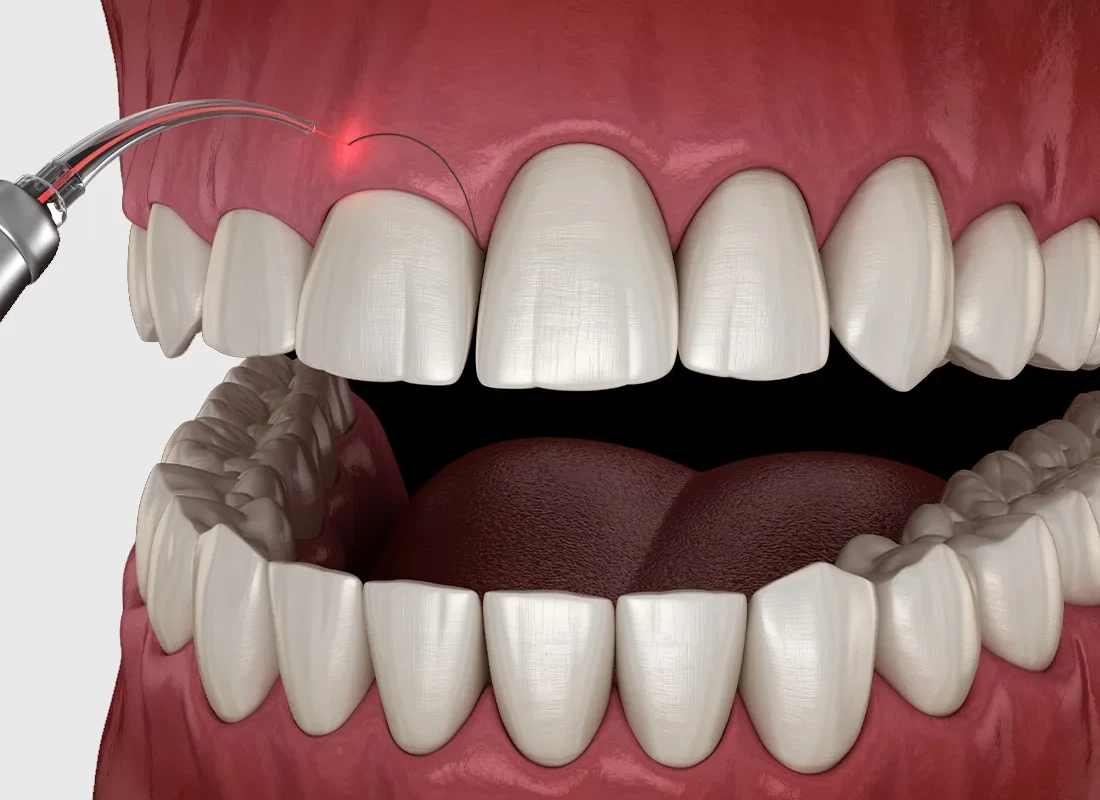 Gum Contouring at Woodland Hills Family Dentistry