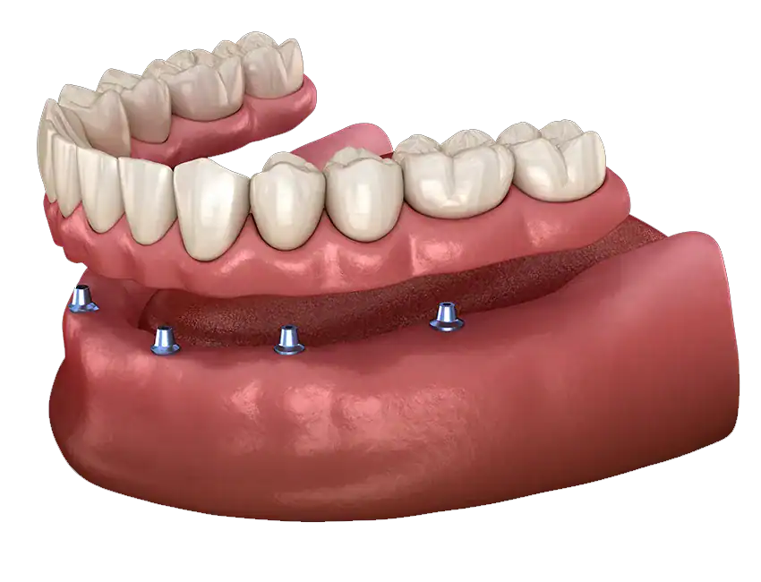 Snap-in Dentures vs. Implants: Which Tooth Replacement Option Is Right for You?