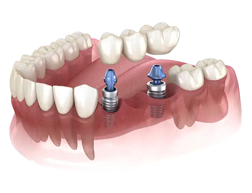 How Dental Implants Near Me Help Woodland Hills Patients Restore Multiple Teeth