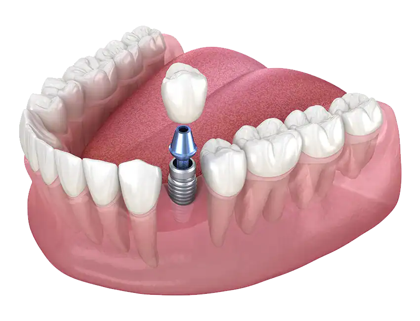 Why Does a Single Untreated Tooth Silently Create Problems?