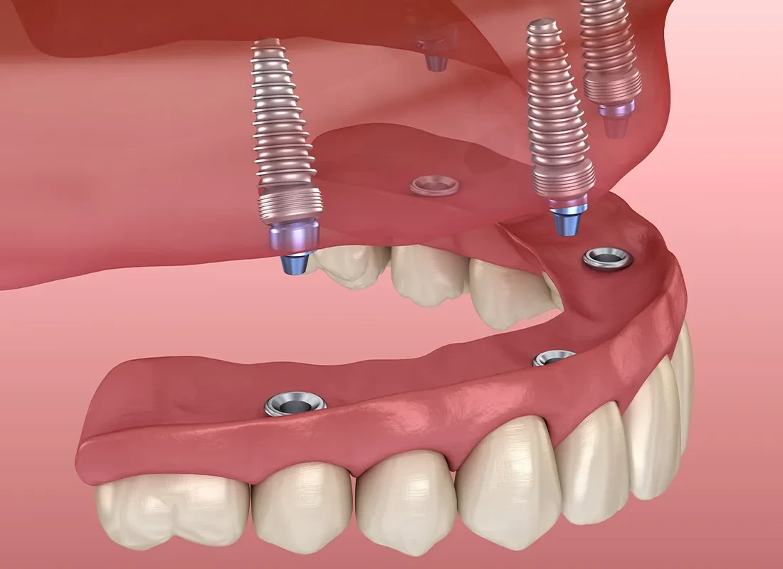 What is All-on-4 Implants