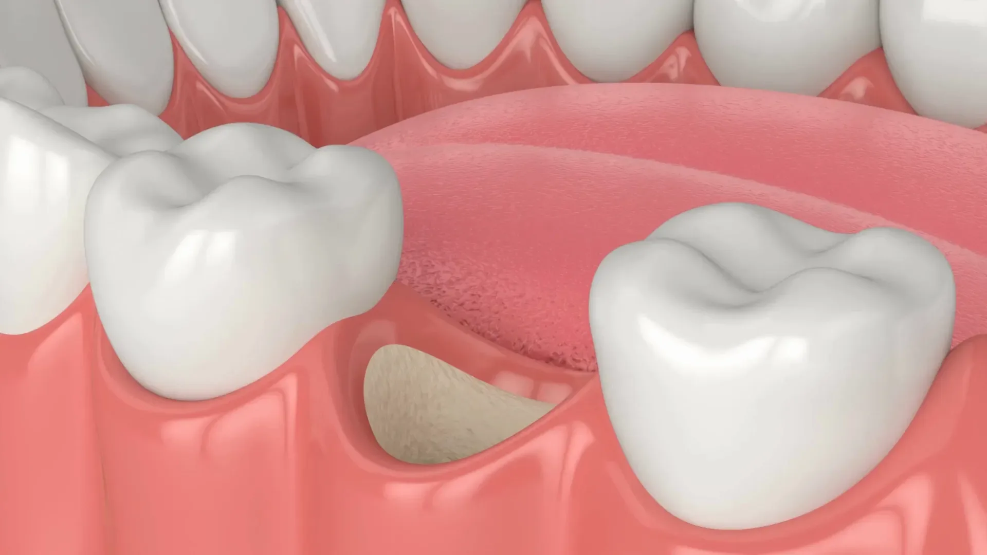 Why Do Some Implants Need a Bone Graft First?