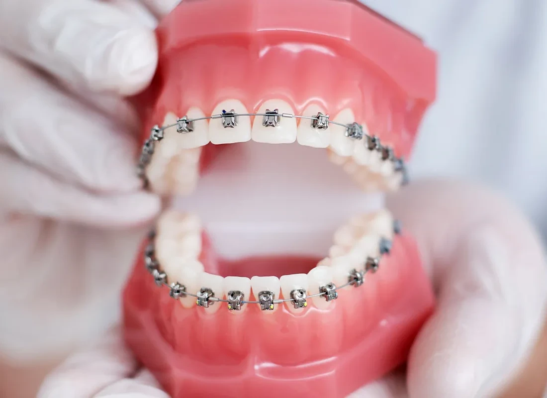 Straighten Your Smile Discreetly with Invisalign at Woodland Hills Family Dentistry