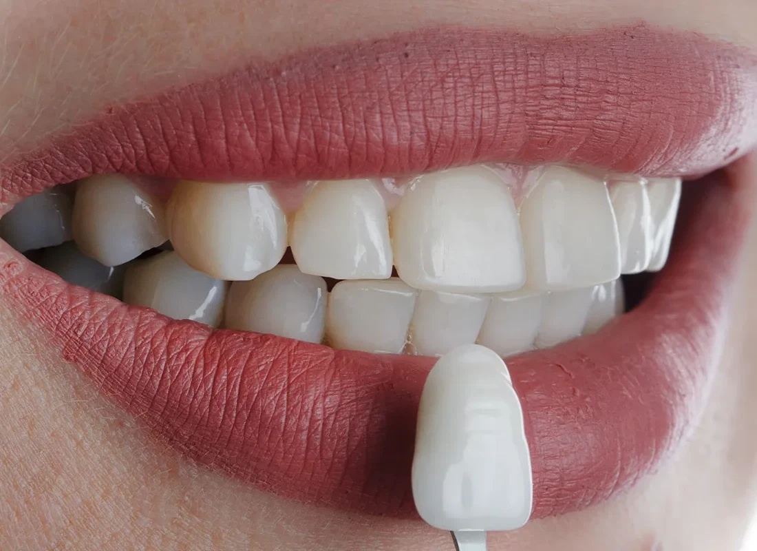 4 Ways a Smile Makeover Can Enhance Your Smile