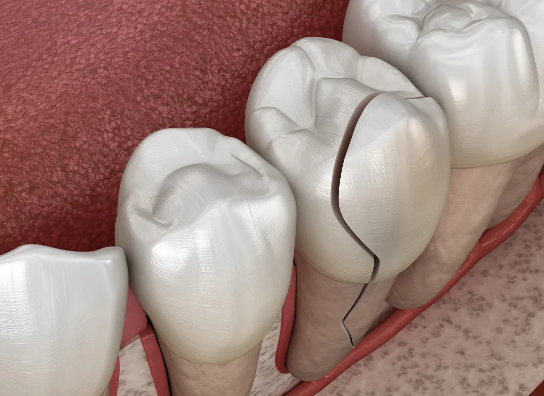 What Should I Do If I Knock Out an Adult Tooth?