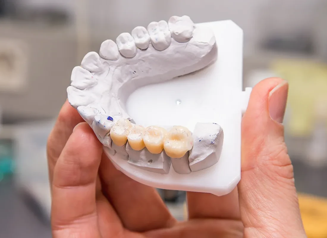 Dental Bridges