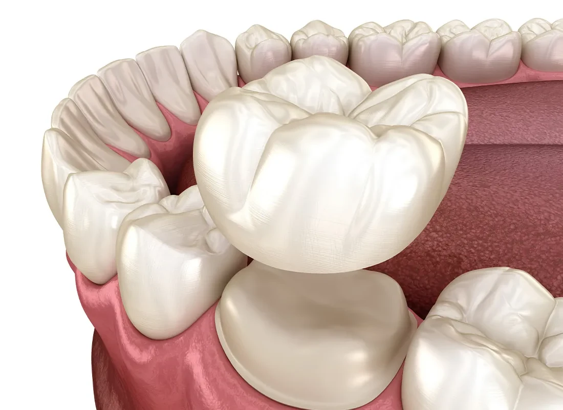 Can You Whiten Teeth That Have Fillings or Crowns?