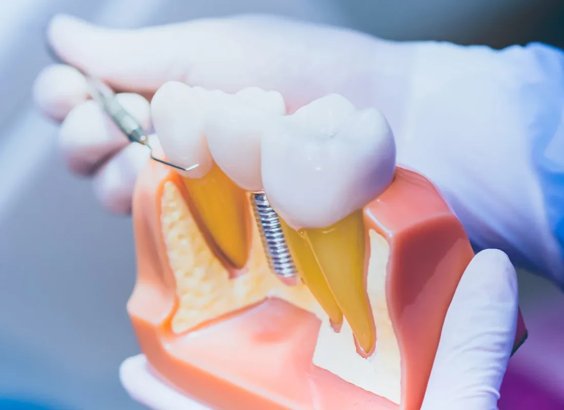 Living with Missing Teeth: Challenges and Solutions Through Dental Implants