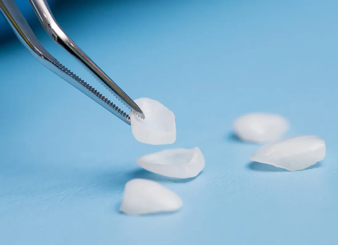 Veneers