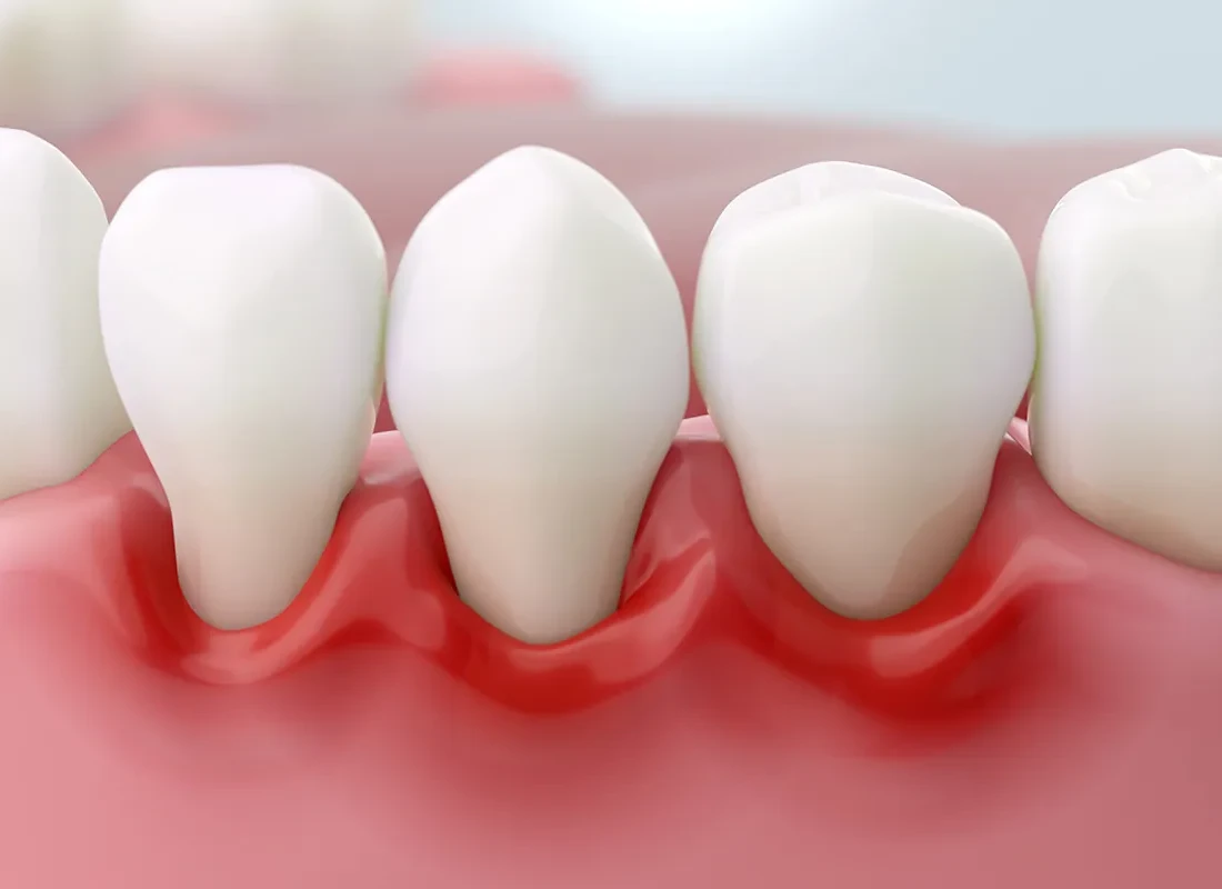 Periodontics at Woodland Hills Family Dentistry