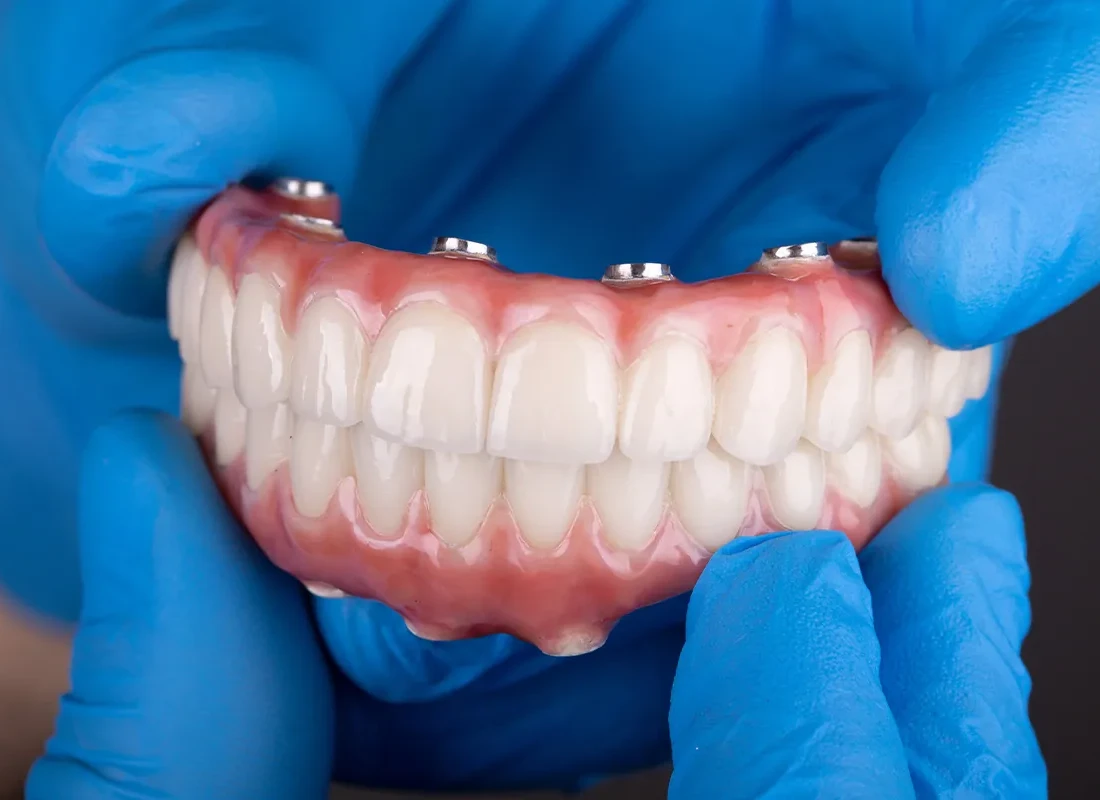 All-on-4 Implants
