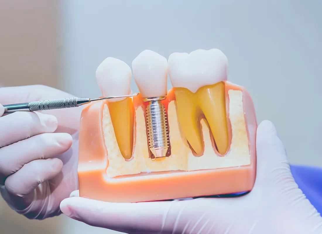 How Painful is Dental Implant Surgery?
