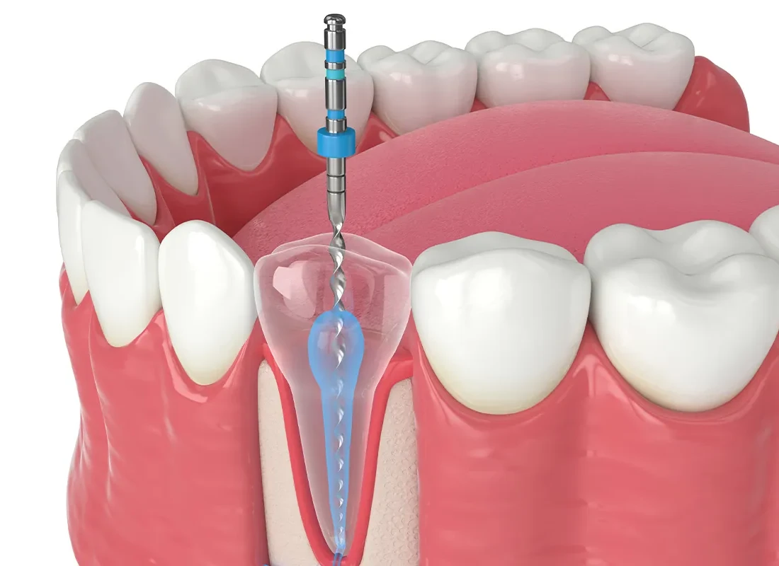 Rediscover Dental Wellness: Root Canal Treatment at Woodland Hills Family Dentistry
