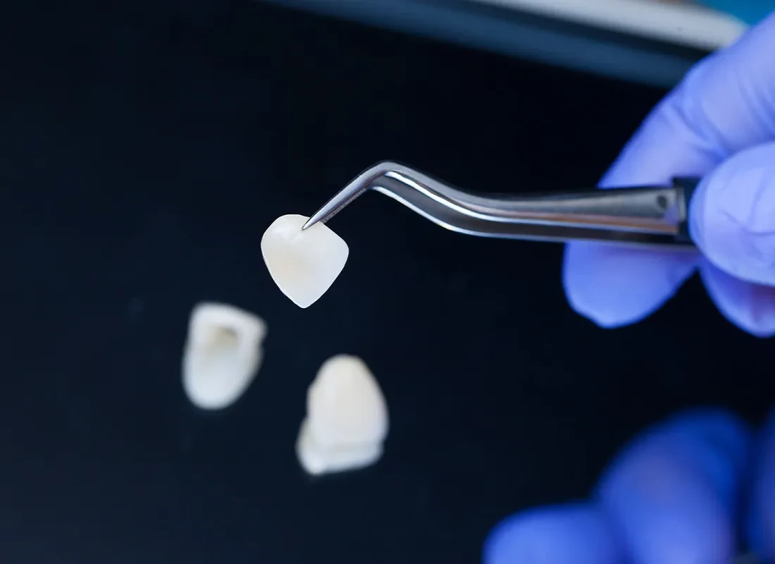 Do You Need Crowns or Veneers?