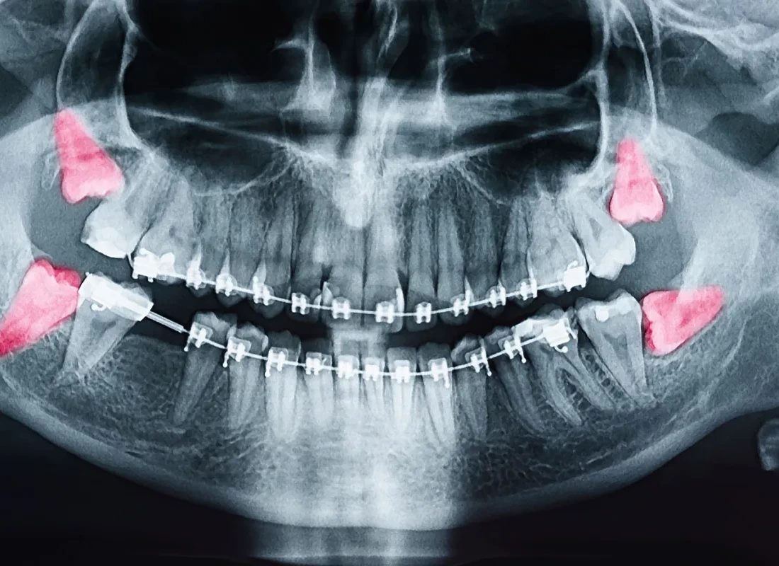 Wisdom Teeth Removal